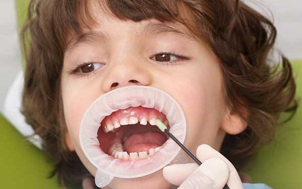 A close-up photograph of a young child wearing a cheek retractor while a dental professional applies a treatment to their teeth with a small applicator brush.