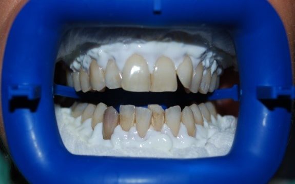A close-up intraoral photograph showing teeth undergoing a professional in-office whitening procedure with a blue cheek retractor and protective gum barrier applied.