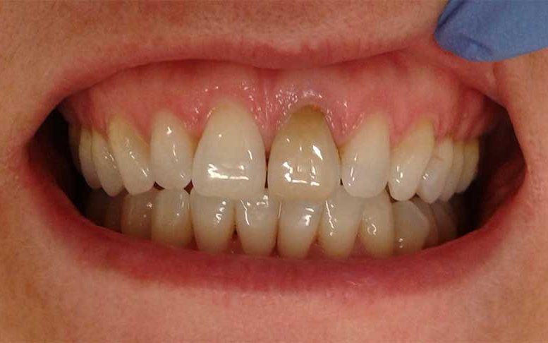 A close-up intraoral photograph showing upper and lower teeth with a single discolored upper front tooth.