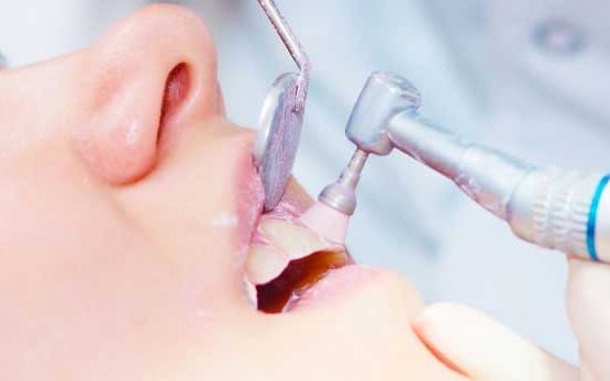 A close-up photograph of a patient receiving a professional dental polishing and cleaning procedure using a dental handpiece and mirror.