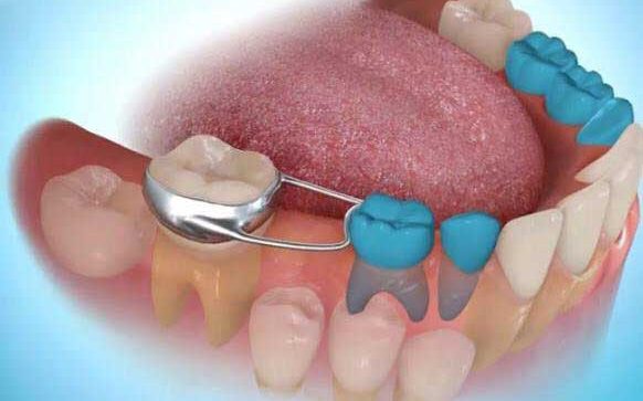 A 3D medical illustration showing a lower dental arch with a space maintainer appliance fitted around a molar and a tooth.