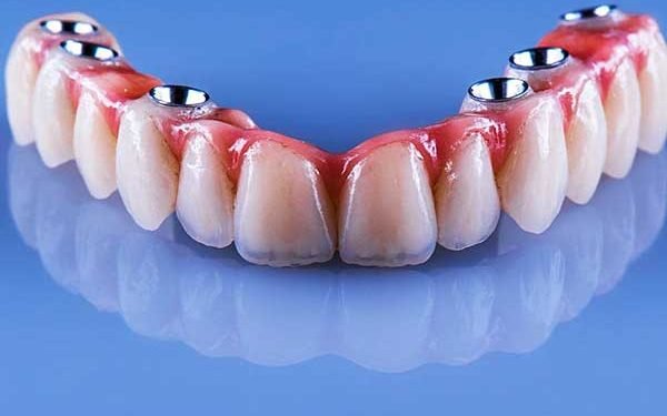 A photograph of an implant-supported dental prosthesis or full-arch bridge set against a blue reflective background.
