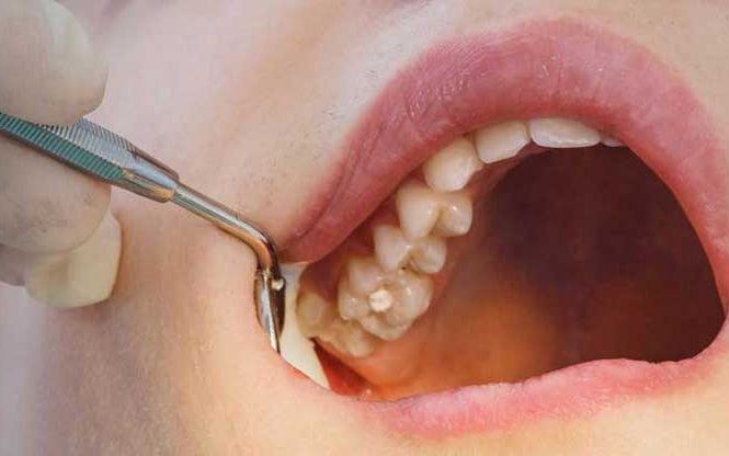 A close-up intraoral photograph of a dental examination showing a dentist using a mouth mirror to inspect the upper teeth.