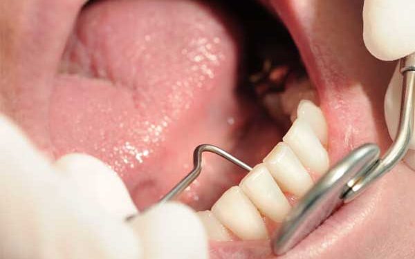 A close-up intraoral photograph showing a dental professional using an explorer tool and a mouth mirror to examine a patient's lower teeth.