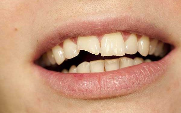 A close-up intraoral photograph showing a chipped upper front tooth.