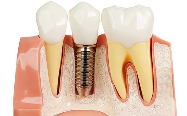 A cross-section model of a jaw showing a dental implant embedded in the bone with a crown replacing a missing tooth.