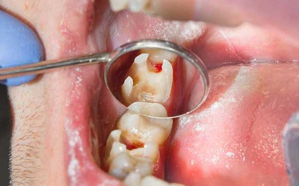 A close-up intraoral photograph showing a severely decayed molar tooth being examined with a dental mirror.