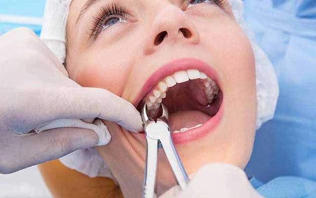 A close-up photograph of a dental procedure where a professional uses forceps during a treatment session.