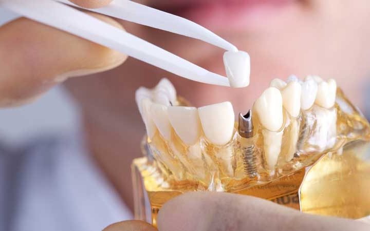 A close-up photograph of a dental model showing tweezers placing a dental crown onto a metal implant abutment.