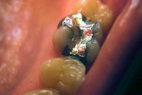 A close-up intraoral photograph showing a molar tooth with a polished silver amalgam filling.