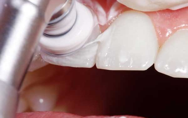 A close-up photograph of a professional dental polishing procedure using a rotary cup and prophylaxis paste on the front teeth.