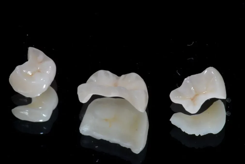 A close-up studio photograph of three custom ceramic dental restorations, including crowns and onlays, displayed on a reflective black surface.