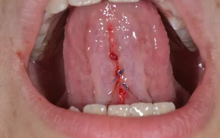 A close-up intraoral photograph showing a tongue with a vertical surgical incision closed with blue sutures.