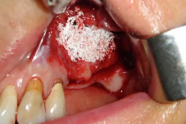 A close-up intraoral photograph showing bone grafting material placed in a surgical site on the jaw during a dental procedure.