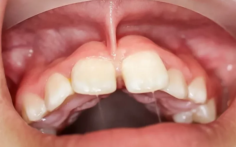 A close-up intraoral photograph of a pronounced labial frenulum extending down between the upper central incisors, causing a dental gap.