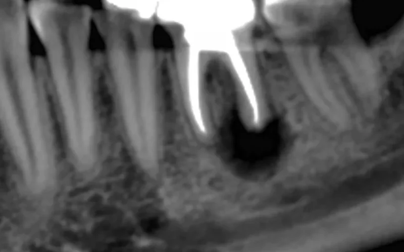 A dental X-ray radiograph showing a molar with a root canal treatment and an area of bone resorption or infection surrounding the root tips.