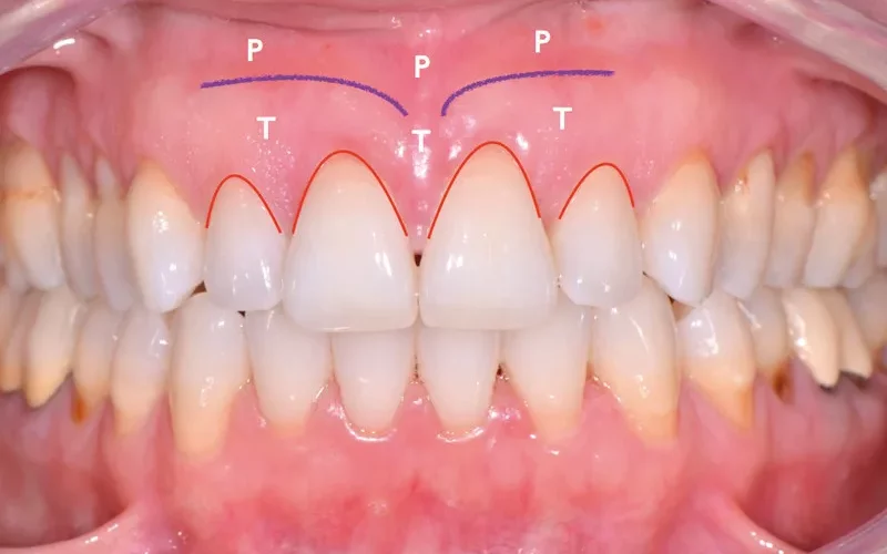 A close-up intraoral photograph showing an upper dental arch with red and purple surgical markings overlaid on the gums and teeth for a procedure.
