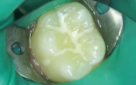 A close-up clinical photograph showing an isolated molar tooth undergoing a restorative procedure with a dental dam and matrix band in place.