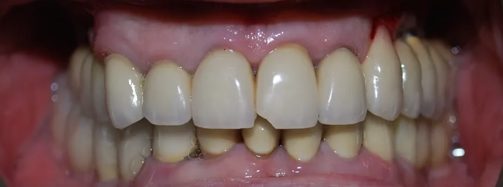 A close-up dental photograph displaying upper and lower teeth with existing restorations and gum tissue.