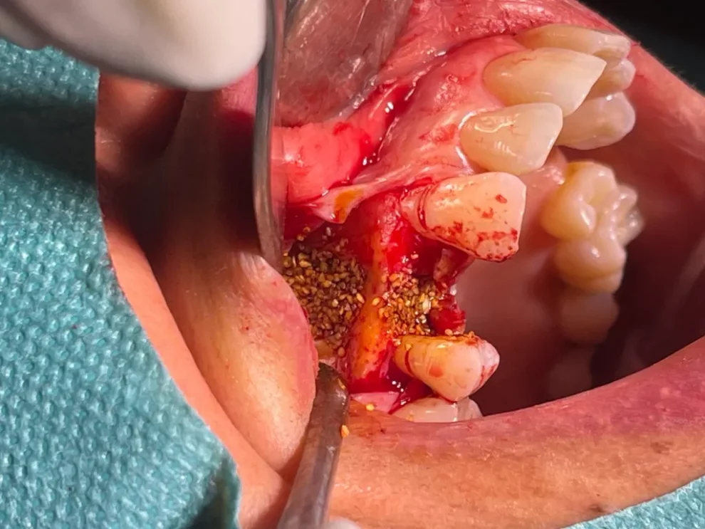 A clinical close-up photograph of a dental bone grafting procedure, showing bone graft granules placed at the surgical site alongside dental instruments and exposed tooth roots.