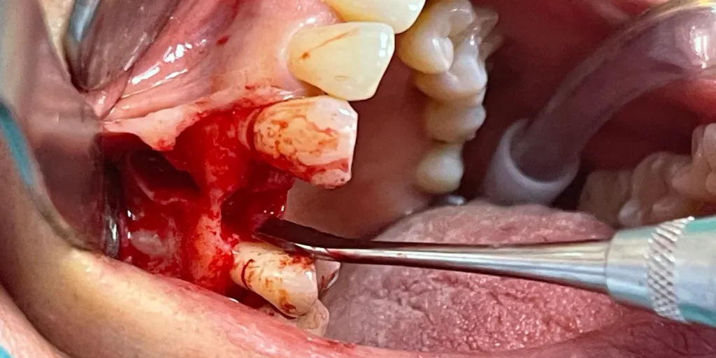 A clinical close-up photograph of a dental surgical procedure in progress, showing a surgical site with exposed bone, dental instruments, and teeth.