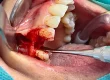 A clinical close-up photograph of a dental surgical procedure in progress, showing a surgical site with exposed bone, dental instruments, and teeth.