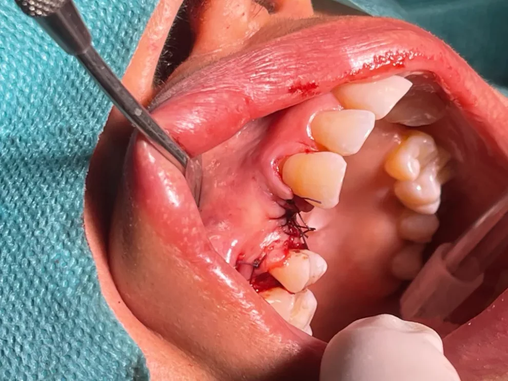 A clinical close-up photograph of a dental procedure showing post-surgical suturing on the gum tissue alongside dental instruments.