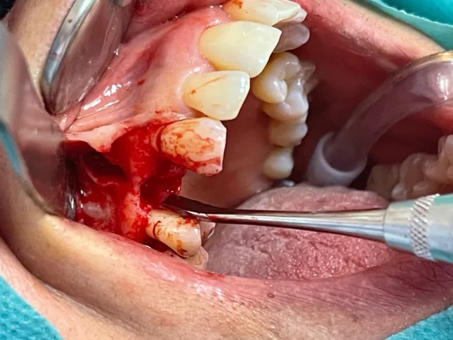A clinical close-up photograph of a dental surgical procedure in progress, showing a surgical site with exposed bone, dental instruments, and teeth.