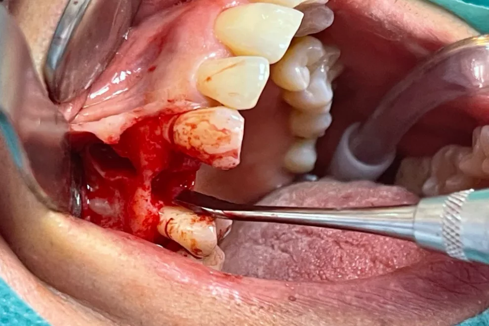 A clinical close-up photograph of a dental surgical procedure in progress, showing a surgical site with exposed bone, dental instruments, and teeth.