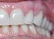 A close-up photograph of teeth showcasing healthy gums and clean dental alignment.