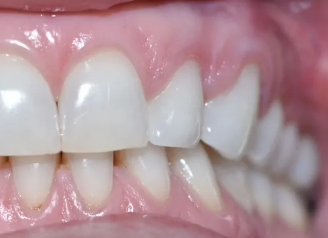 A close-up photograph of teeth showcasing healthy gums and clean dental alignment.