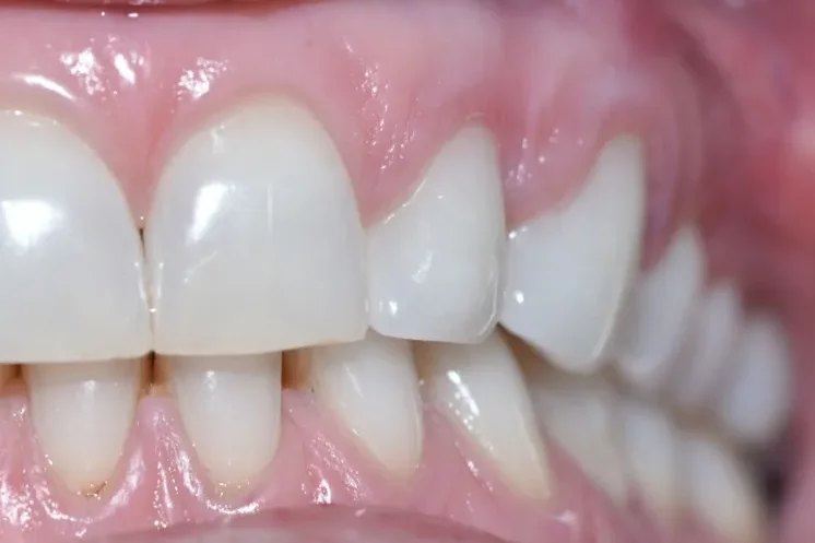 A close-up photograph of teeth showcasing healthy gums and clean dental alignment.
