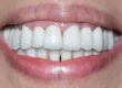 A close-up photograph of a bright, healthy smile showcasing clean upper and lower teeth.