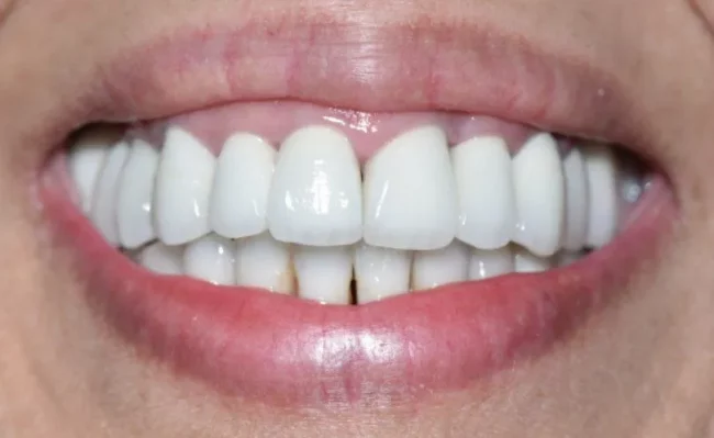A close-up photograph of a bright, healthy smile showcasing clean upper and lower teeth.