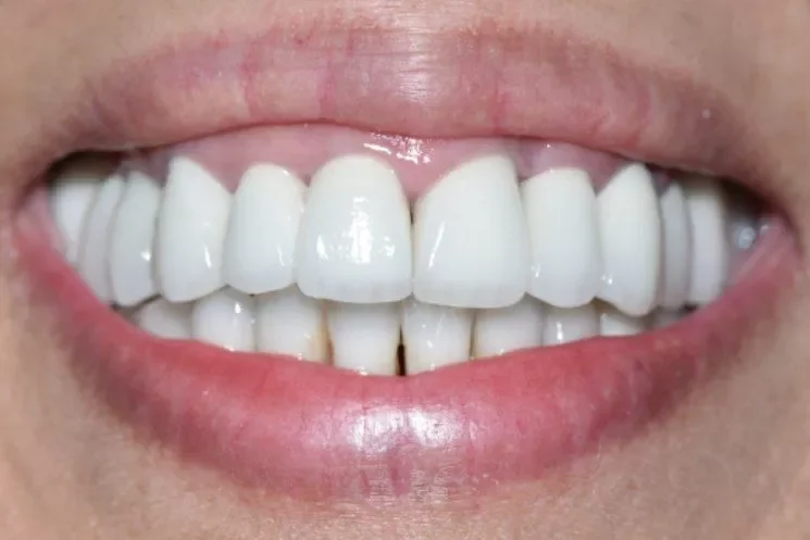 A close-up photograph of a bright, healthy smile showcasing clean upper and lower teeth.