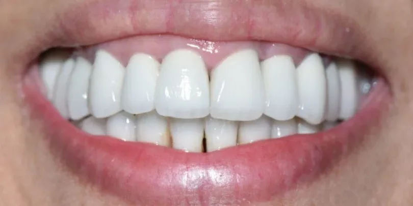 A close-up photograph of a bright, healthy smile showcasing clean upper and lower teeth.