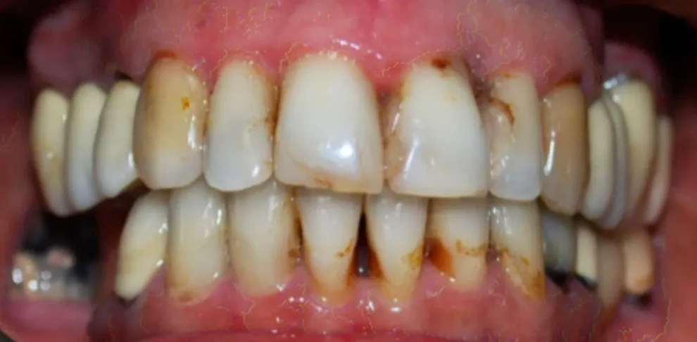 Extreme close-up clinical photo of a patient's upper and lower teeth showing significant staining and discoloration.