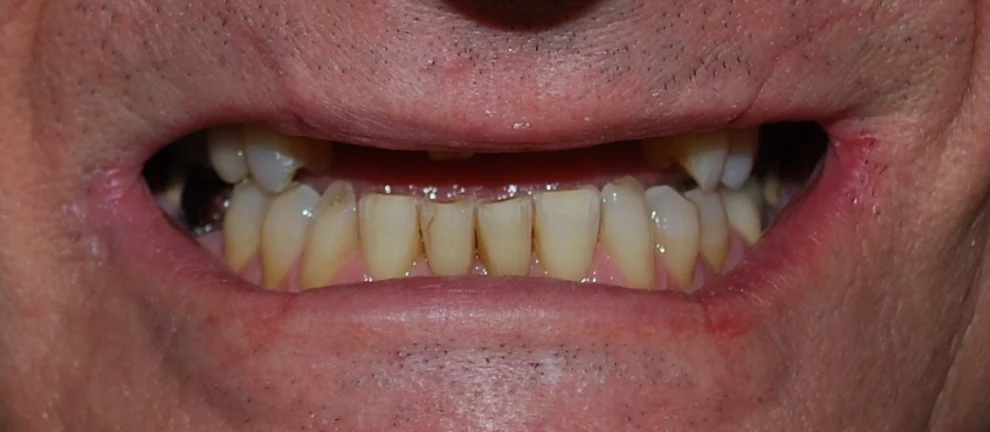 A close-up photograph of a person's smile showing natural lower teeth and the upper dental arch before restorative work.
