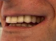 A close-up photograph of a person's smile displaying side-profile upper and lower teeth with natural-looking dental restorations.