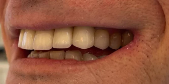 A close-up photograph of a person's smile displaying side-profile upper and lower teeth with natural-looking dental restorations.