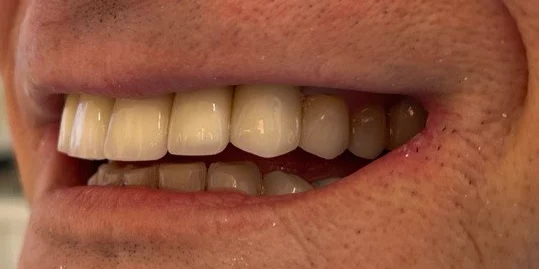 A close-up photograph of a person's smile displaying side-profile upper and lower teeth with natural-looking dental restorations.