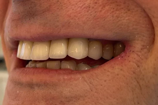 A close-up photograph of a person's smile displaying side-profile upper and lower teeth with natural-looking dental restorations.