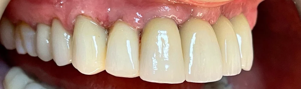 A close-up clinical photograph showing a row of beautifully aligned upper dental restorations and healthy gums.