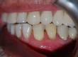 A close-up clinical photograph showing a lateral view of upper and lower teeth, highlighting occlusion and healthy gum tissue with a dental retractor in place.