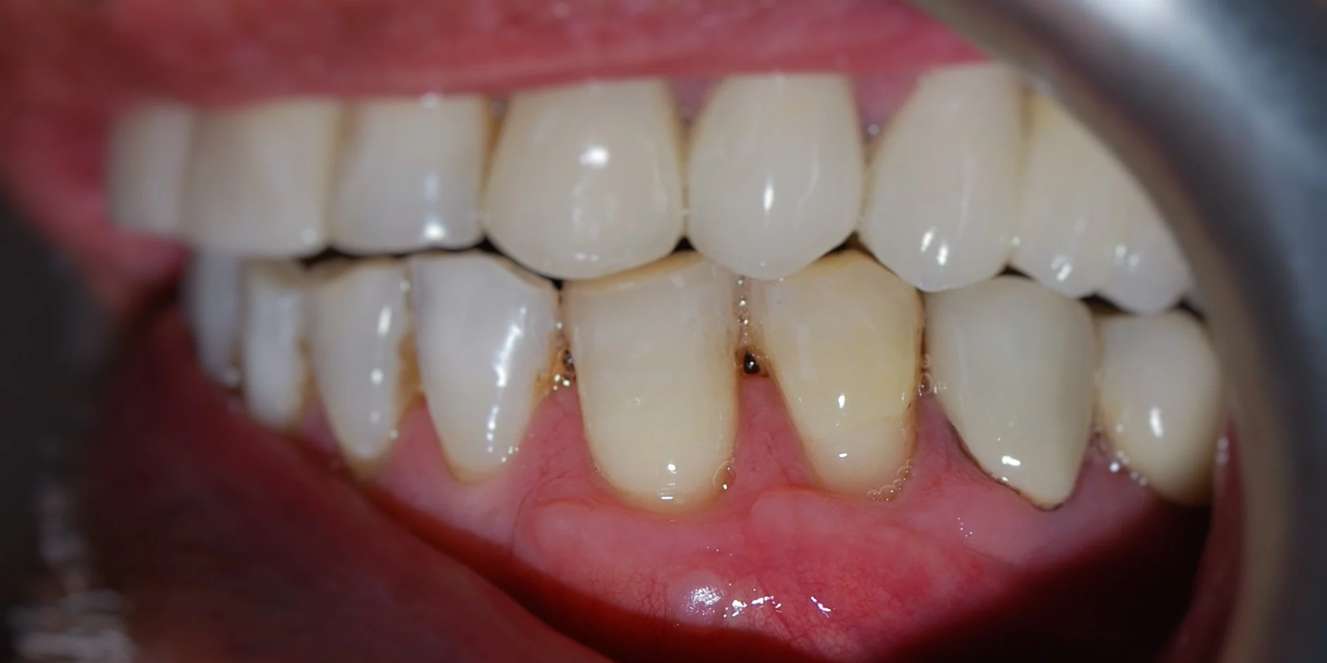 A close-up clinical photograph showing a lateral view of upper and lower teeth, highlighting occlusion and healthy gum tissue with a dental retractor in place.