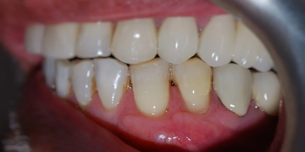 A close-up clinical photograph showing a lateral view of upper and lower teeth, highlighting occlusion and healthy gum tissue with a dental retractor in place.