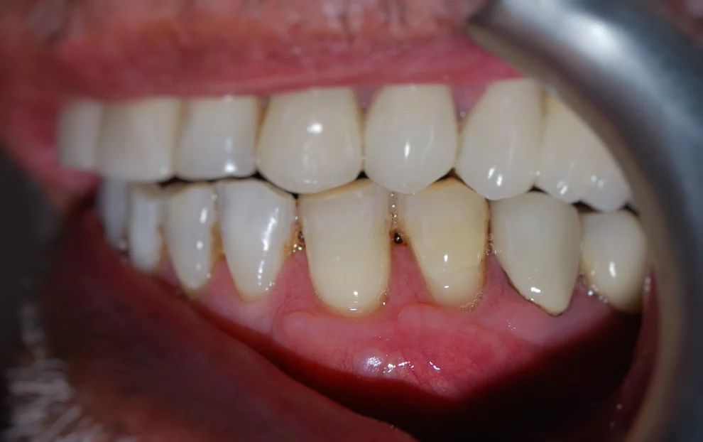 A close-up clinical photograph showing a lateral view of upper and lower teeth, highlighting occlusion and healthy gum tissue with a dental retractor in place.