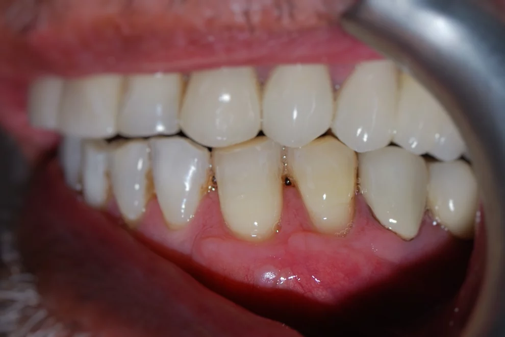 A close-up clinical photograph showing a lateral view of upper and lower teeth, highlighting occlusion and healthy gum tissue with a dental retractor in place.