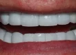 A close-up photograph of a bright, confident smile showcasing perfectly aligned, uniform white upper and lower teeth.