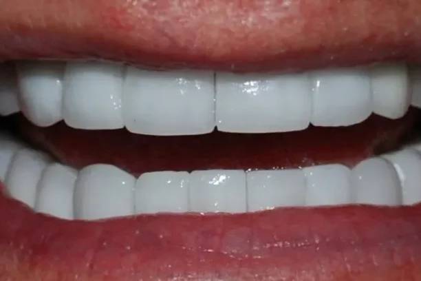 A close-up photograph of a bright, confident smile showcasing perfectly aligned, uniform white upper and lower teeth.
